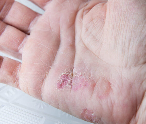 Horizontal  close up image of very dry cracked and peeling skin in the palm of a caucasian woman