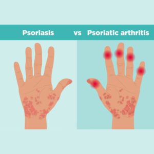 Psoriasis - GHLF.org