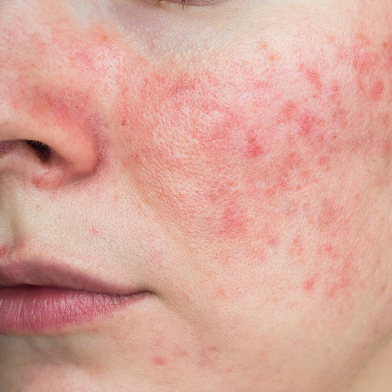 A photo of a persons face with rosacea, as evident my red patches of skin.
