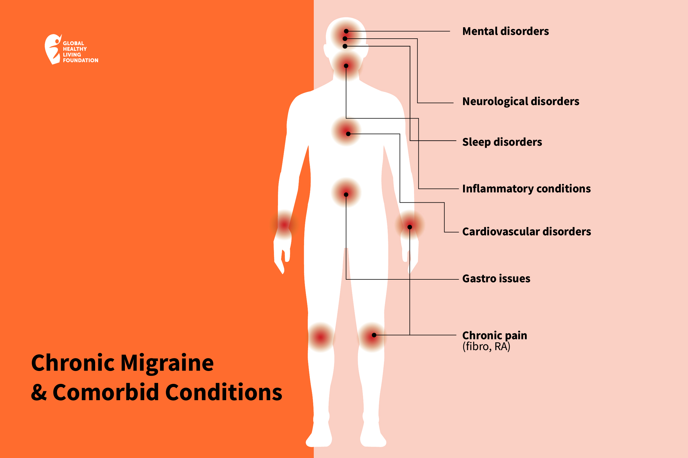 migraine headache diagram